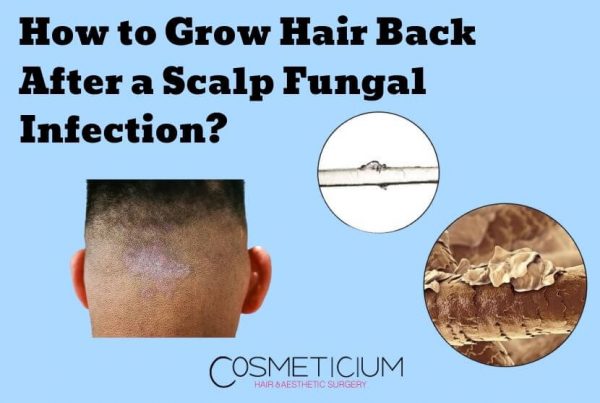 Grow Hair Back After a Scalp Fungal Infection