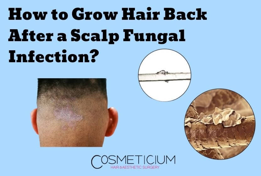 head scalp fungus