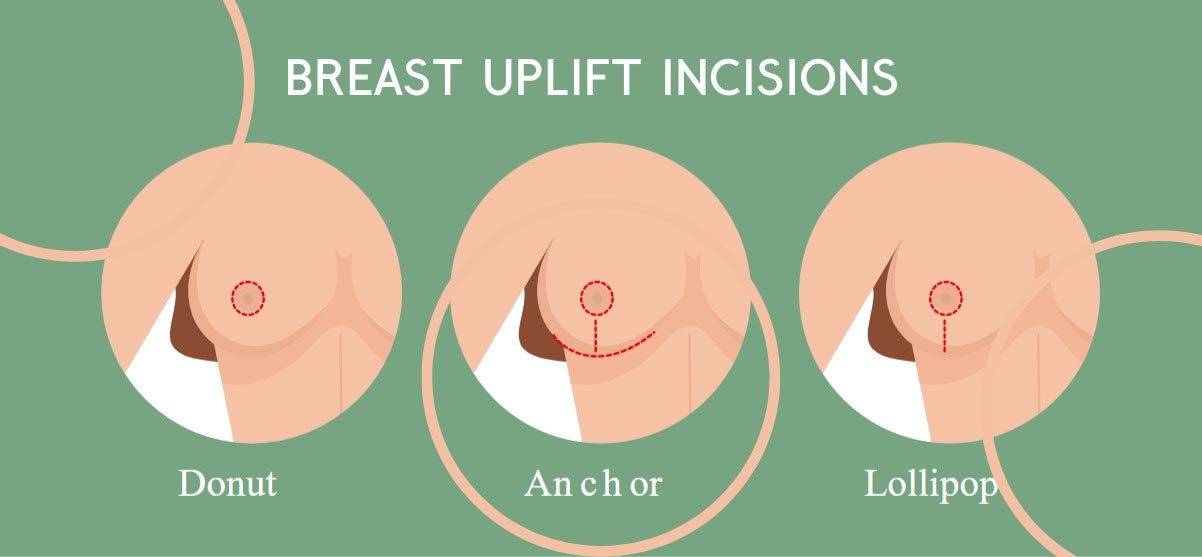breast-uplift-types