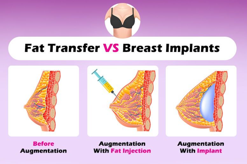 Breast Implants Versus Fat Transfer: Pros and Cons Of Each Procedure