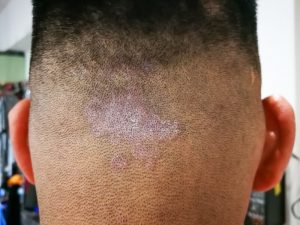 Hair Loss Fungal