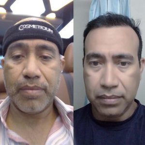 Cosmeticium-Hair-Transplant-Before-After-Result-2