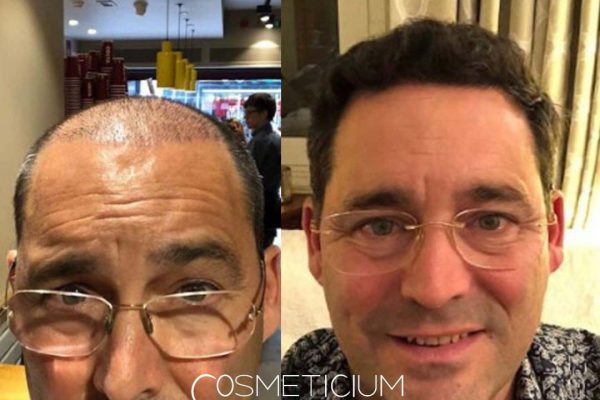 Cosmeticium-Hair-Transplant-Before-After-Result-3