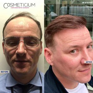 Cosmeticium-Hair-Transplant-Before-After-Result