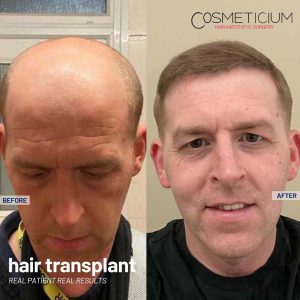 Cosmeticium-Hair-Transplant-Before-After-Result-4