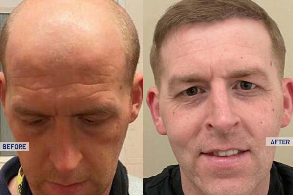 Cosmeticium-Hair-Transplant-Before-After-Result-4