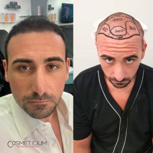 Cosmeticium-Hair-Transplant-Before-After-Result-5