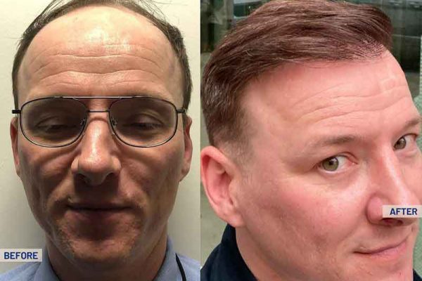 Cosmeticium-Hair-Transplant-Before-After-Result