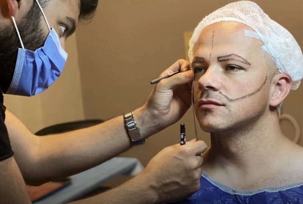 Cosmeticium beard transplantation in turkey 2
