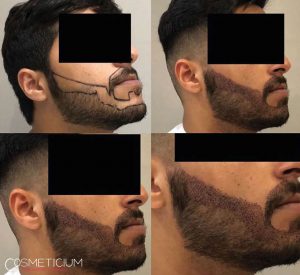 Cosmeticium beard transplantation in turkey