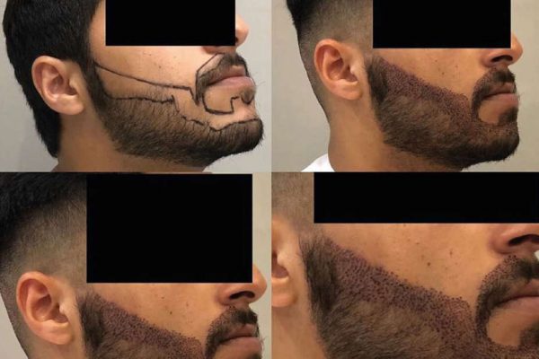 Cosmeticium beard transplantation in turkey