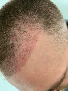 hair transplant redness