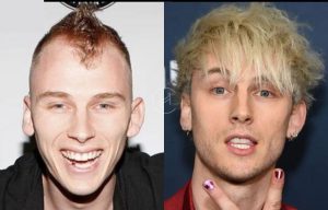 Machine-Gun-Kelly-Hair-Transplant