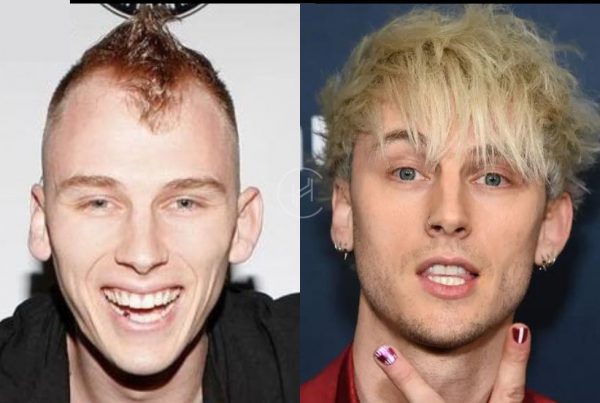 machine gun kelly hair transplant