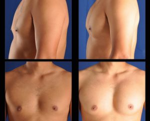 breast implant surgery for men