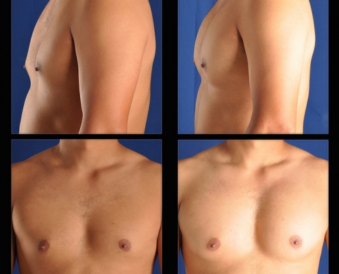 Breast implant can be done to men’s breast?