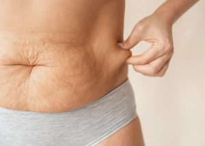 Saggy Skin