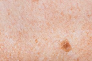 Keloid Scarring Affect Hair Transplants