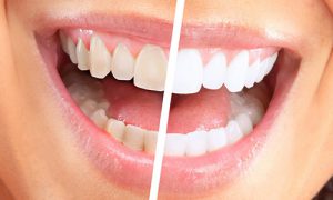 Dental Crowns