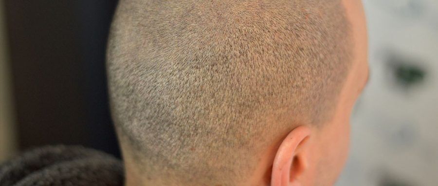 Don’t Have Enough Donor Area for Hair Transplant