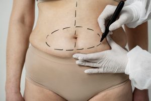 Benefits of a Mommy Makeover