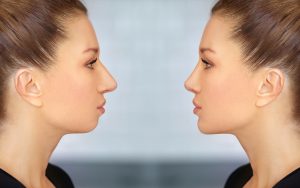 chin surgery