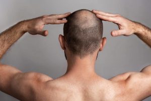 head crown area