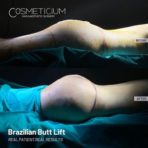 BBL (Brazilian Butt Lift) Before After Result