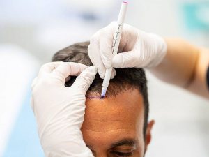 Hair Transplant