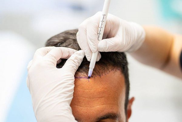Hair Transplant