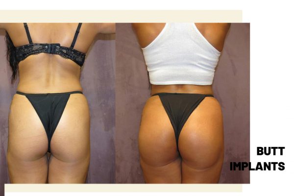 BBL (Brazilian Butt Lift) Before After Result 3