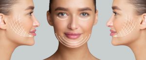 Facelift
