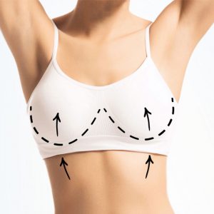 Breast Lift