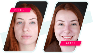 nose job-Before-After