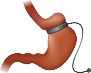 gastric band surgery in turkey