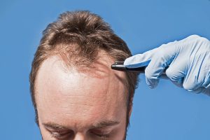 Hair Transplant