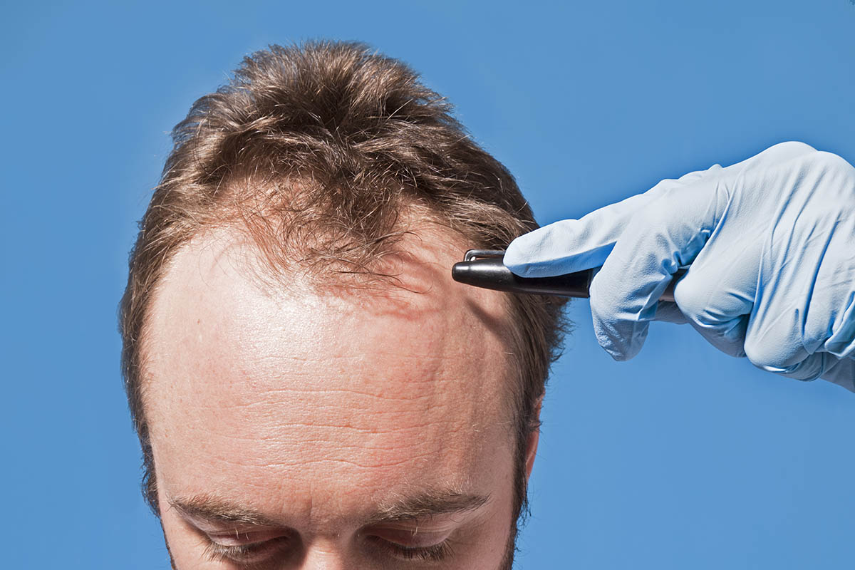 Hair Transplant 