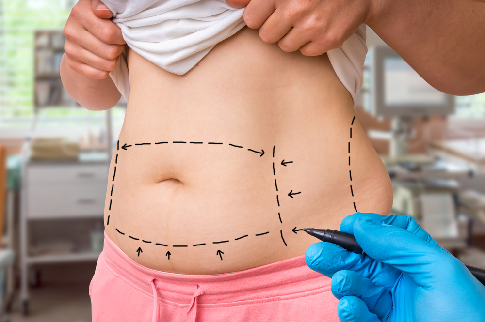 What Medications to Avoid Before Your Tummy Tuck Surgery