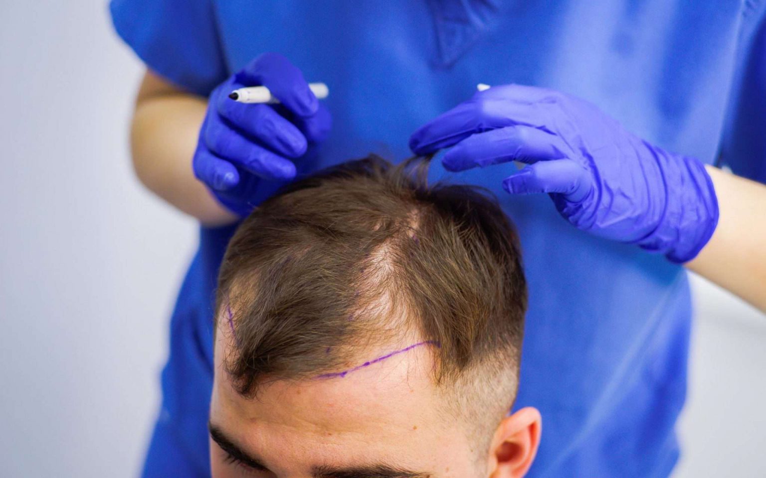 the-ultimate-guide-to-preparing-for-a-hair-transplant