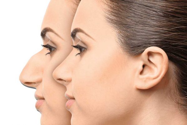 Rhinoplasty