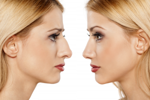 Rhinoplasty