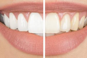 Teeth Whitening