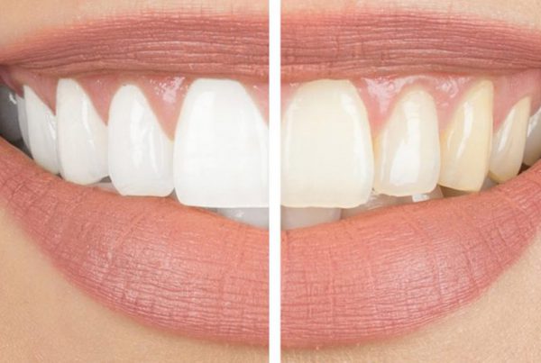 Teeth Whitening