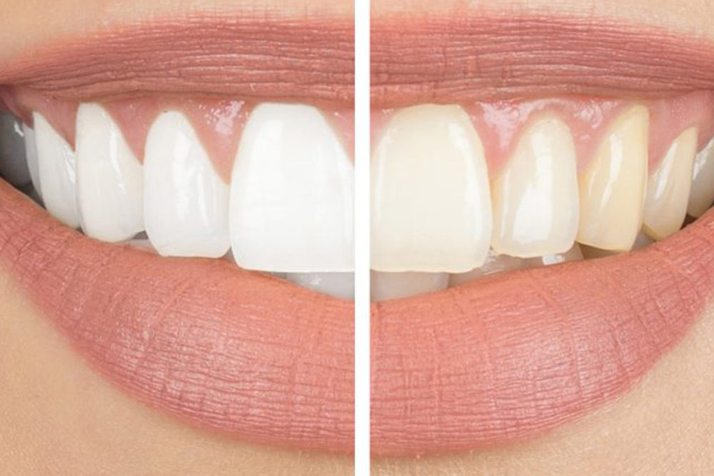 The Ultimate Guide to Whitening Dentures: What You Need to Know