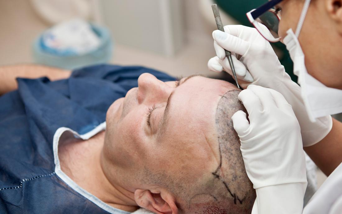 Tips for Caring for Your Scalp after a Hair Transplant to Minimize Scar Formation
