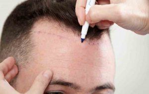 Hair Transplant