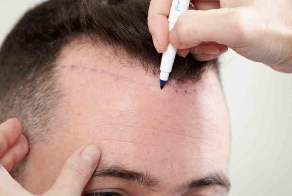 Hair Transplant