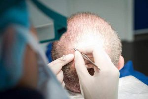 Hair Transplant