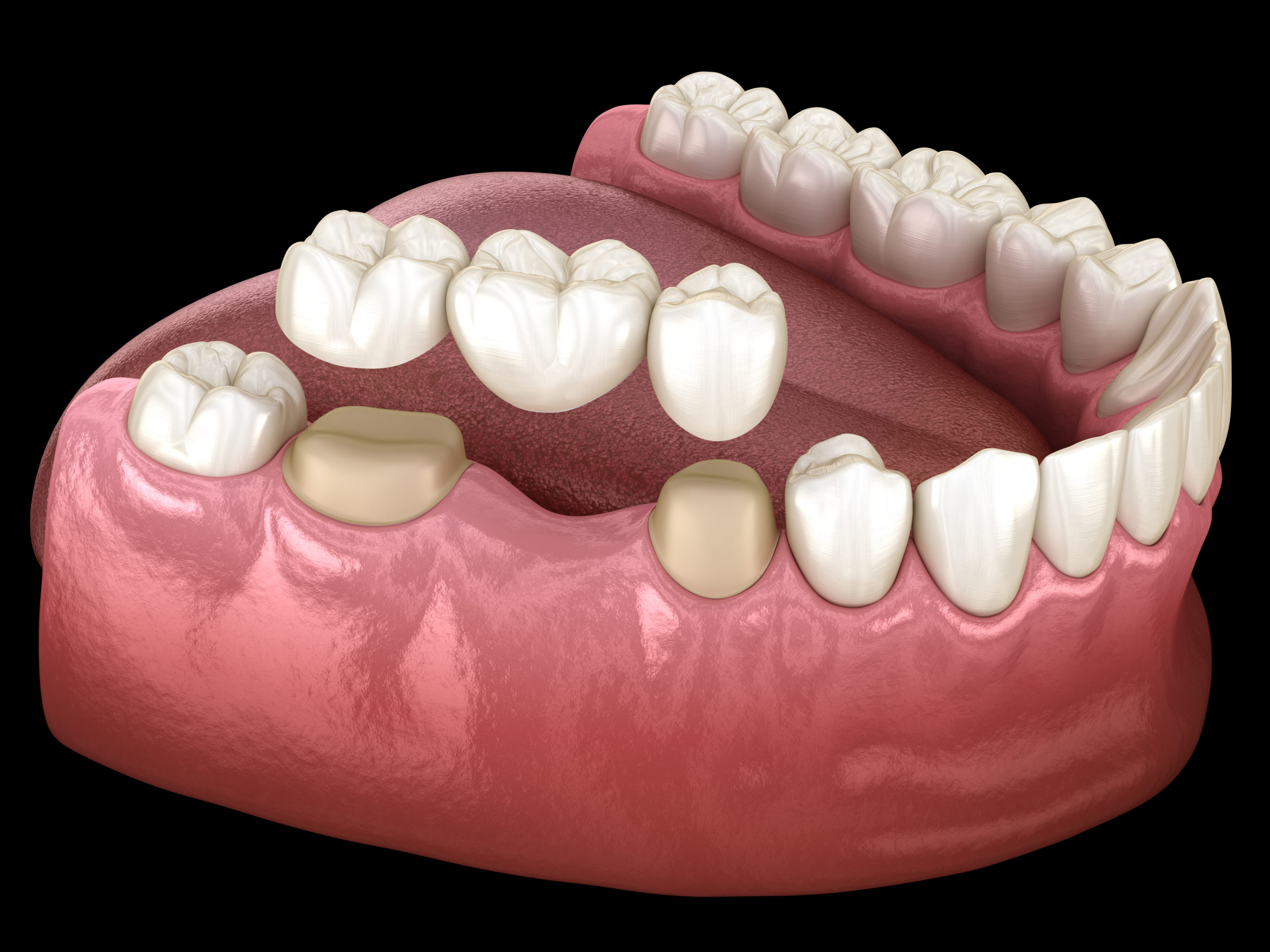 Dental Bridge and Composite Bonding