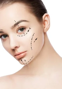 Facelift
